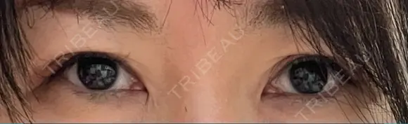 眉下切開 松下皮フ形成外科 BEFORE メイン用