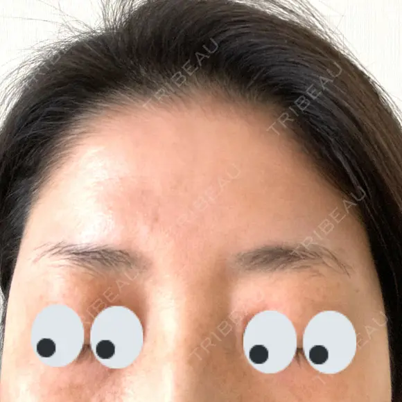 アートメイク（眉） AIM Beauty Medical Clinic BEFORE メイン用