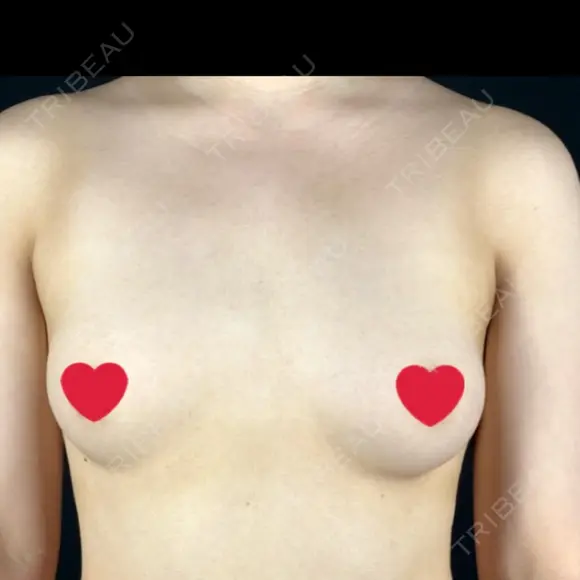 豊胸（シリコンバッグ） MYCLI【マイクリ】東京・恵比寿院 BEFORE メイン用