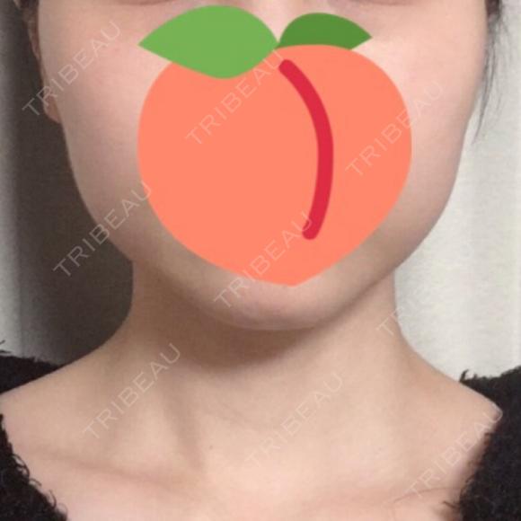 脂肪溶解注射（顔） / ハイフ（顔） リエンジャン整形外科 江南店 BEFORE メイン用
