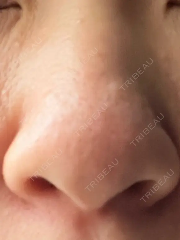 隆鼻術 / 鼻尖形成（切開） / 軟骨移植 白山クリニック 大分 BEFORE メイン用