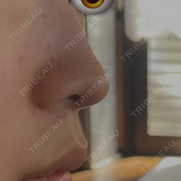 軟骨移植 フェアクリニック川口 BEFORE メイン用