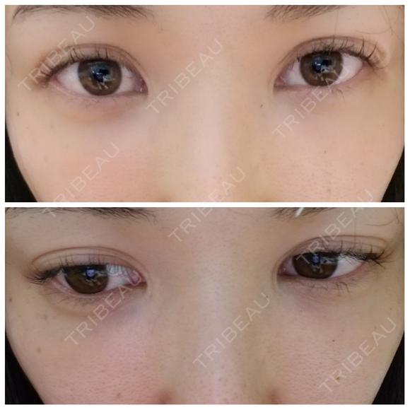 二重埋没 アロマ美容外科クリニック BEFORE メイン用