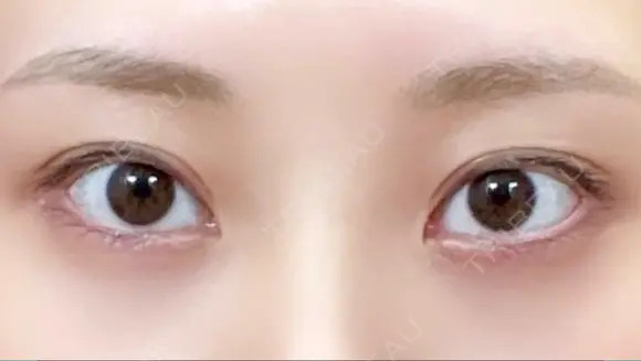 目尻切開 / タレ目形成・グラマラスライン（切開） / 目尻靭帯移動 eクリニック 金沢本院 BEFORE メイン用