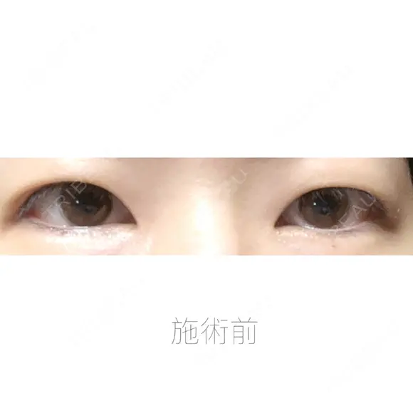 二重埋没 湘南美容クリニック 福島院 BEFORE メイン用