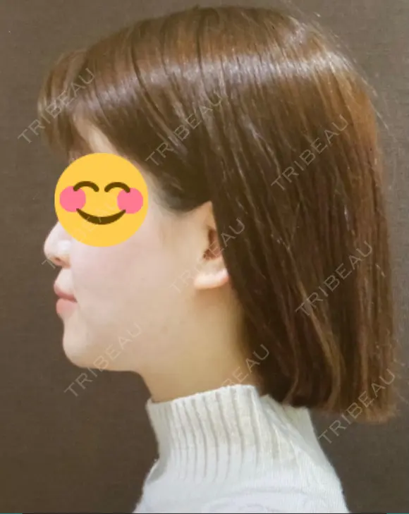 骨切り（あご） / 骨削り（エラ） / その他（輪郭） / セットバック アーククリニック BEFORE メイン用
