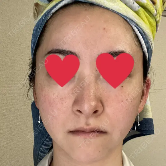 隆鼻術 / 鼻尖形成（切開） / 軟骨移植 湘南美容クリニック 辻堂アカデミア BEFORE メイン用