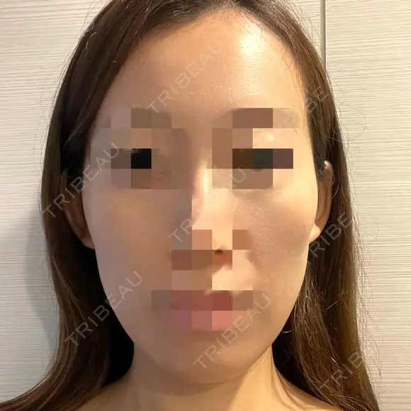 骨切り（あご） 銀座マイアミ美容外科 BEFORE メイン用