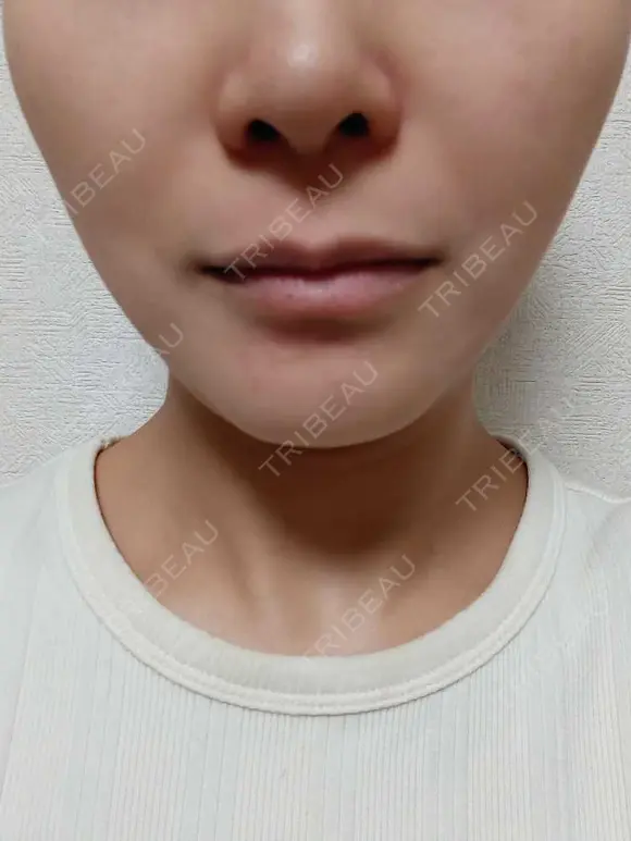 小鼻縮小（切開） / 人中短縮 / 口角挙上 / その他（口元） オザキクリニック LUXE新宿 BEFORE メイン用