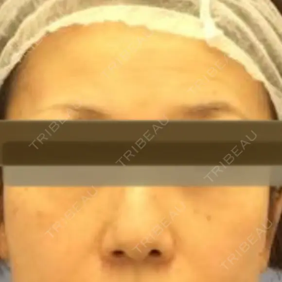 鼻尖縮小 リッツ美容外科 大阪院 BEFORE メイン用