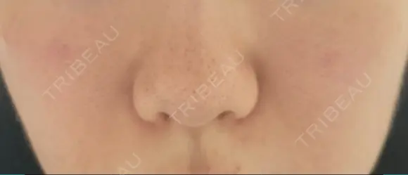 鼻翼基部形成（貴族手術） ノーチェビューティクリニック BEFORE メイン用