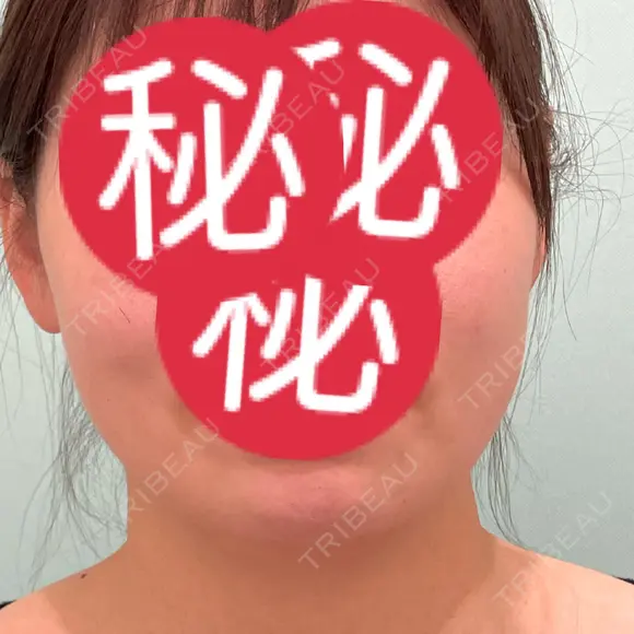 その他（輪郭） / 医療痩身（顔） WOM CLINIC GINZA （ワム クリニック ギンザ） BEFORE メイン用