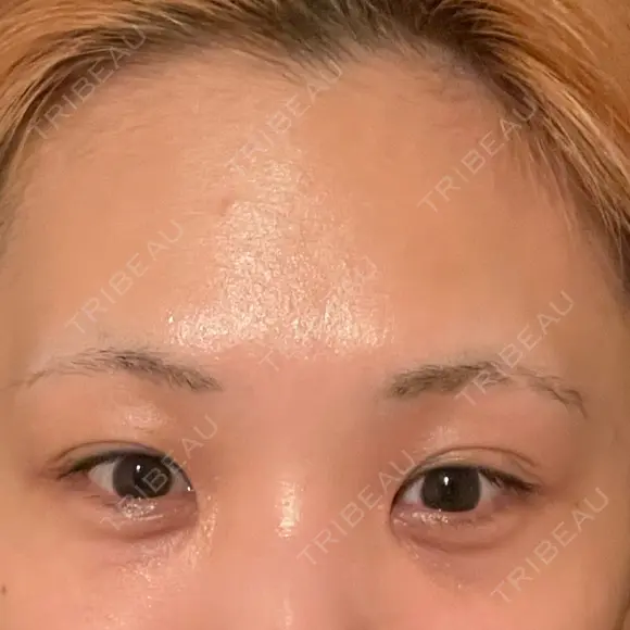 目頭切開 / 隆鼻術 / 鼻尖形成（切開） / 軟骨移植 湘南美容クリニック 金山院 BEFORE メイン用