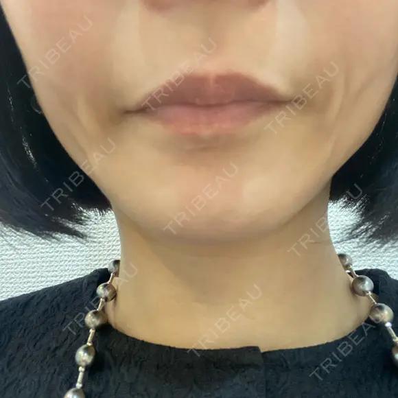 ヒアルロン酸注入（唇） 渋谷美容外科クリニック 新宿院 BEFORE メイン用