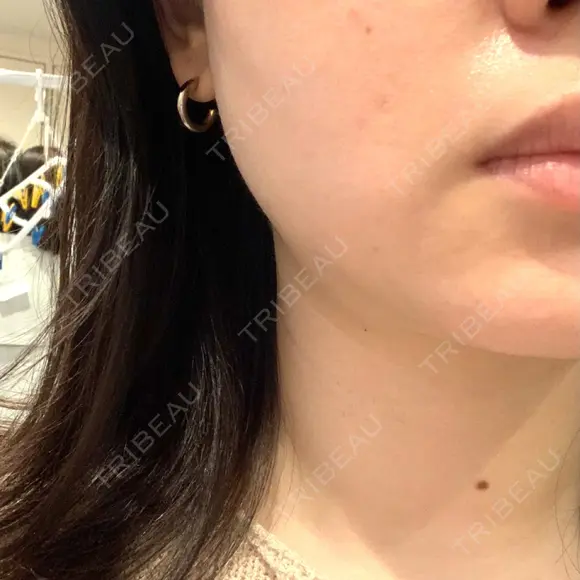 ボトックス（エラ・小顔） TCB東京中央美容外科 銀座有楽町院 BEFORE メイン用