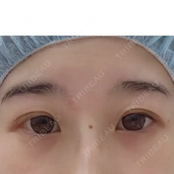眼瞼下垂（切開） リビジョンクリニック（旧：池本形成外科・美容外科） BEFORE メイン用