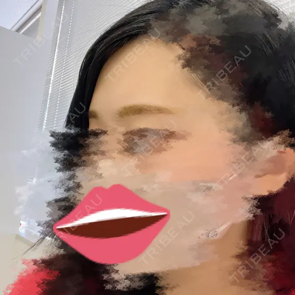 ヒアルロン酸注入（額） MSC LUNA CLINIC 渋谷院 BEFORE メイン用