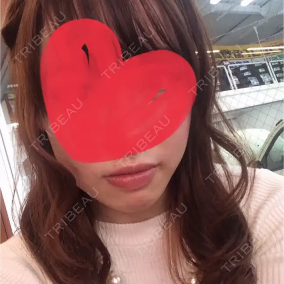 骨切り（あご） 自由が丘クリニック BEFORE メイン用