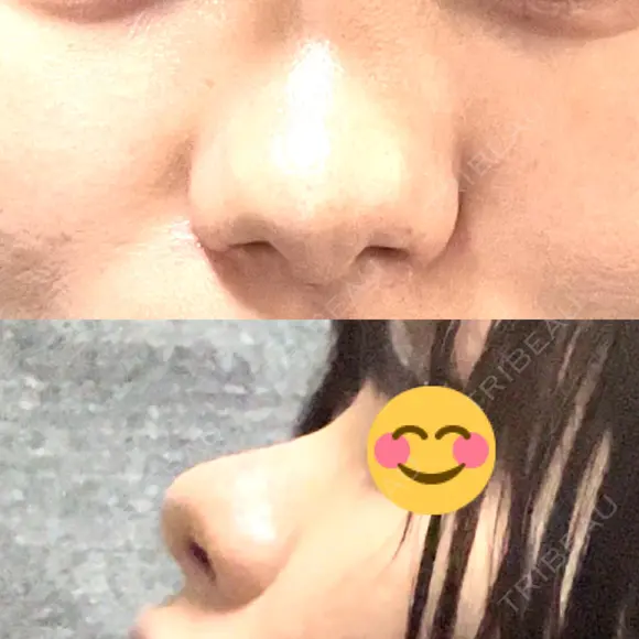 隆鼻術 JUN CLINIC BEFORE メイン用