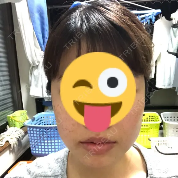 ボトックス（エラ・小顔） 湘南美容クリニック 名古屋栄院 BEFORE メイン用