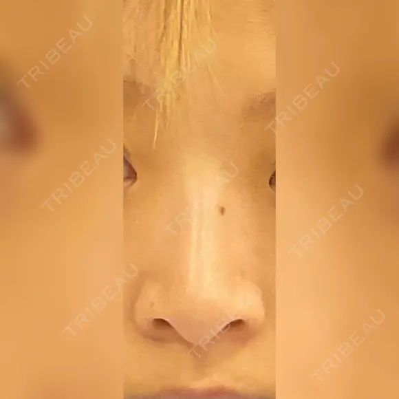 ヒアルロン酸注入（鼻） id美容クリニック 銀座院 BEFORE メイン用