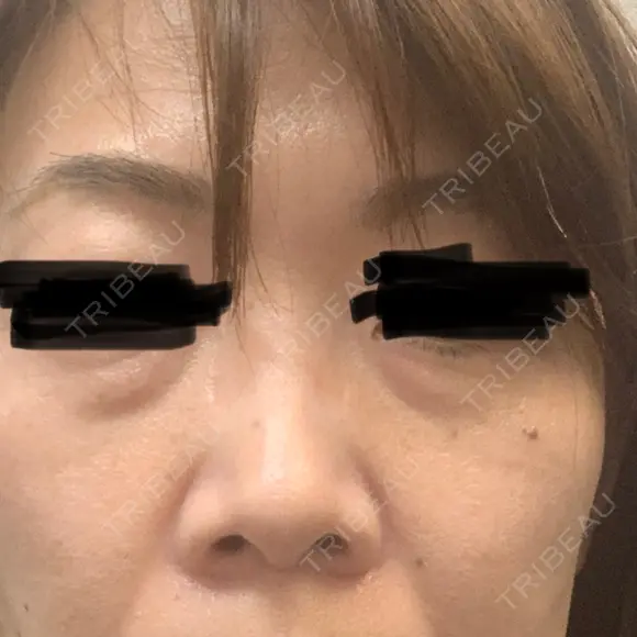 下まぶたの脂肪取り 東郷美容形成外科　福岡 BEFORE メイン用