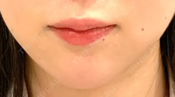 ヒアルロン酸注入（あご） id美容クリニック 銀座院 BEFORE メイン用