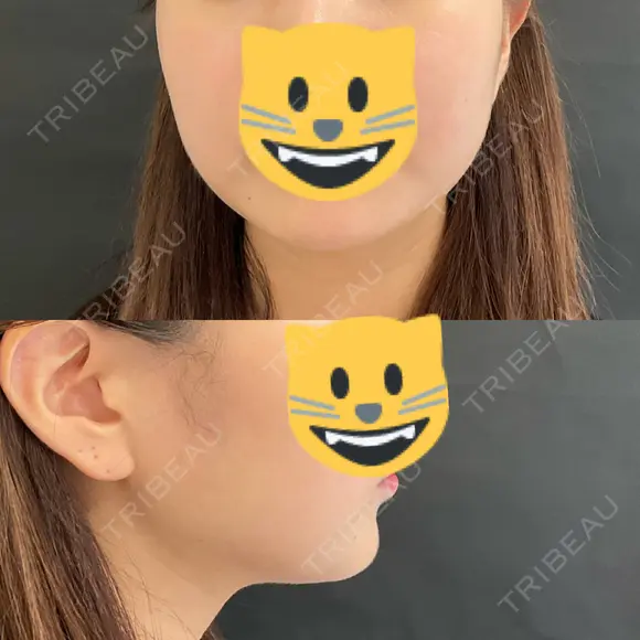 ヒアルロン酸注入（あご） / ボトックス（エラ・小顔） / ボトックス（口角） id美容クリニック 銀座院 BEFORE メイン用