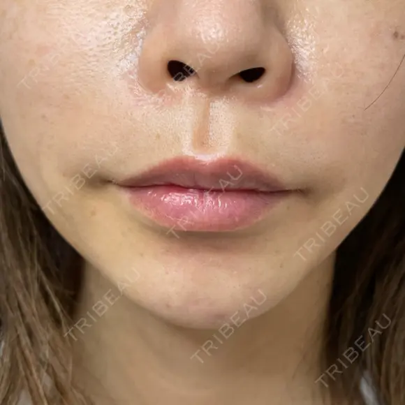 ヒアルロン酸注入（唇） / ボトックス（口角） / ボトックス（人中） ルラ美容クリニック 大宮院 / ルラスキンクリニック 大宮院 BEFORE メイン用