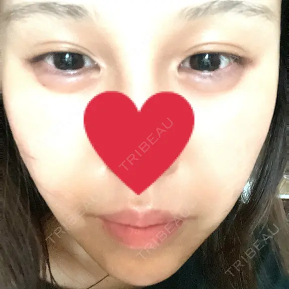 ヒアルロン酸注入（涙袋） / ヒアルロン酸注入（唇） / ボトックス（口角） / ボトックス（人中） HAAB×DREAM BEAUTY CLINIC 東京本院 BEFORE メイン用
