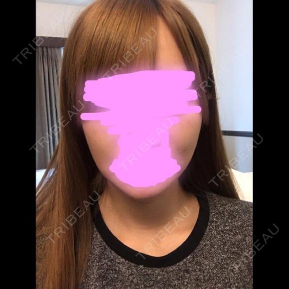 骨削り（エラ） / 骨削り（頬） / その他（輪郭） / 目尻切開 / タレ目形成・グラマラスライン（切開） / 輪郭修正 ウォンジン（Wonjin）整形外科 BEFORE メイン用
