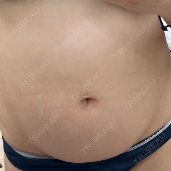 脂肪冷却（お腹） 品川スキンクリニック神戸院（※品川美容外科提携） BEFORE メイン用