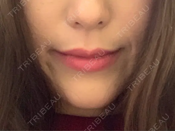 骨切り（あご） / 脂肪吸引（顔） / セットバック / ルフォー+ssro（両あご) リッツ美容外科 東京院 BEFORE メイン用