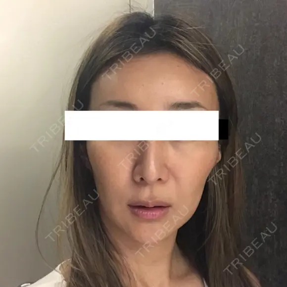 その他（輪郭） / 輪郭修正 ニューセンス皮膚科クリニック BEFORE メイン用