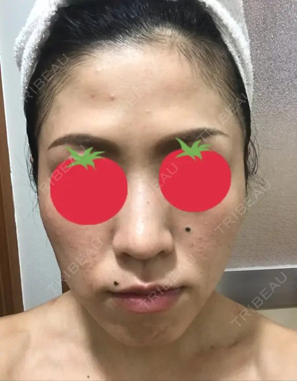 ピーリング（ニキビ・毛穴） / イオン導入 / フォトシルクプラス / ニキビ治療 ハニークリニック BEFORE メイン用