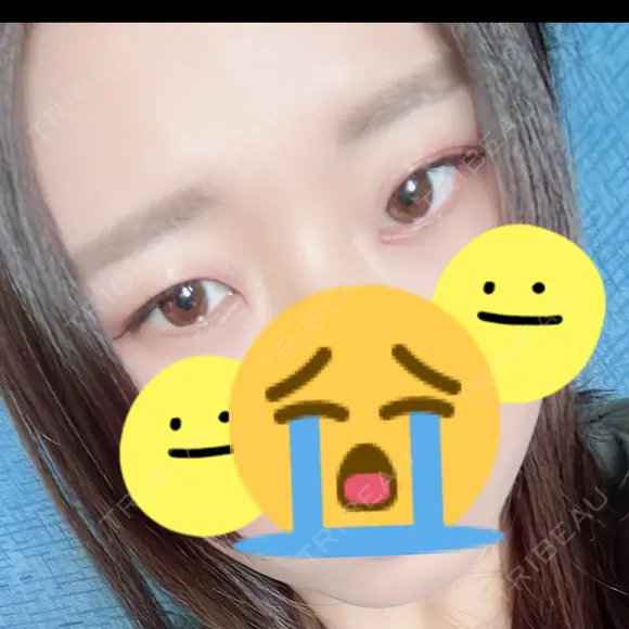 二重埋没 大塚美容形成外科 札幌院 BEFORE メイン用