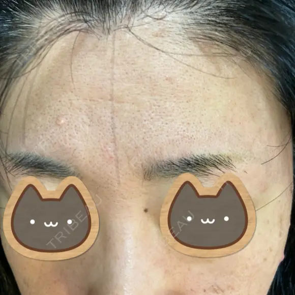 医療脱毛（顔） / 医療脱毛（背中） STARS CLINIC BEFORE メイン用