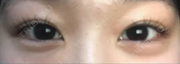 ヒアルロン酸注入（涙袋） Wクリニック 梅田院 BEFORE メイン用