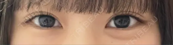 ヒアルロン酸注入（涙袋） Wクリニック 梅田院 BEFORE メイン用