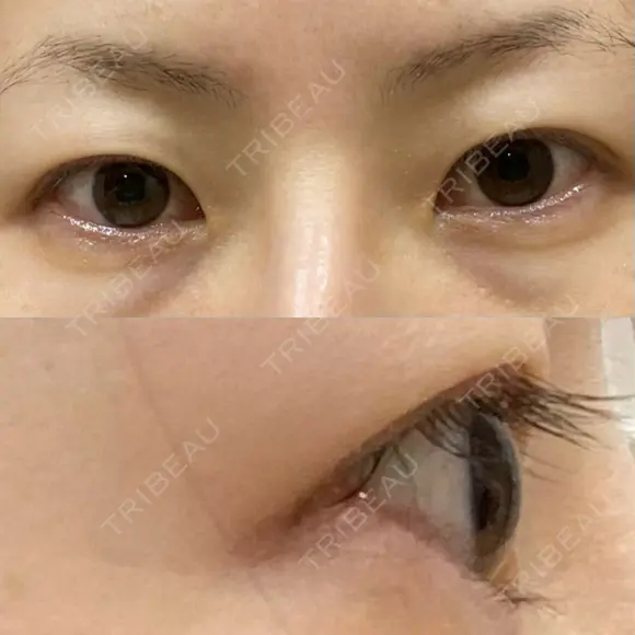 二重切開 / 目尻切開 / 上まぶたの脂肪取り / タレ目形成・グラマラスライン（切開） LIKI CLINIC KOBE BEFORE メイン用