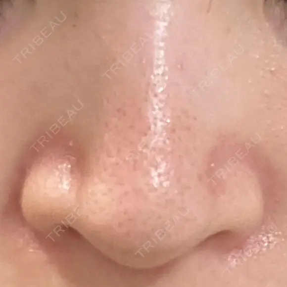 毛穴洗浄（ハイドラフェイシャルなど） STARS CLINIC BEFORE メイン用