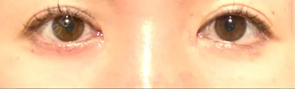 リジュラン 湘南美容クリニック 岡山院 BEFORE メイン用