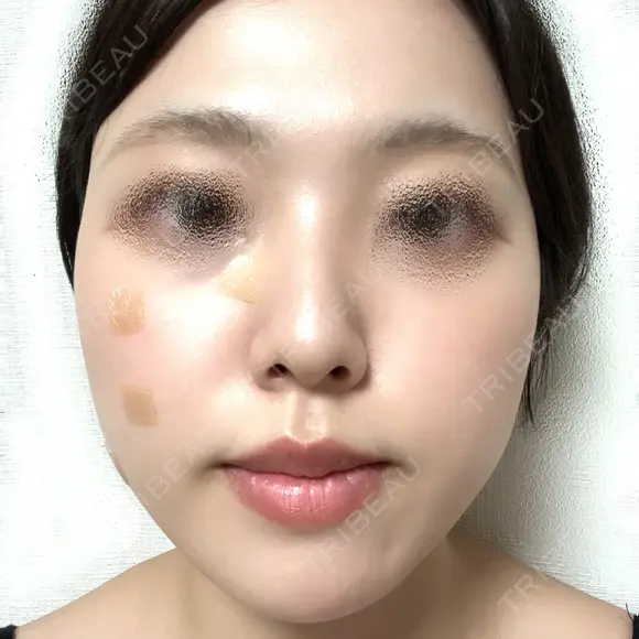 鼻尖形成（切開） / 軟骨移植 / ヒアルロン酸注入（涙袋） / ヒアルロン酸注入（唇） / ボトックス（口角） / ヒアルロン酸注入（額） 東京シンデレラ美容外科 池袋院 BEFORE メイン用