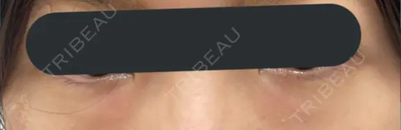 下まぶたの脂肪取り BRIGHTS beauty clinic BEFORE メイン用