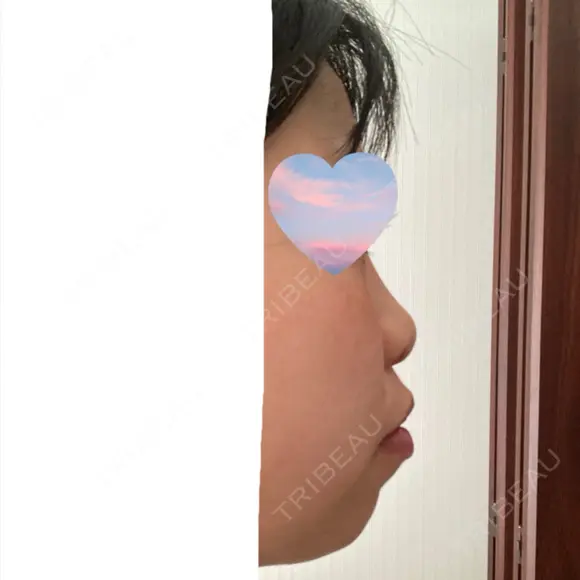 鼻尖形成（切開） Olino美容外科・美容皮膚科 BEFORE メイン用