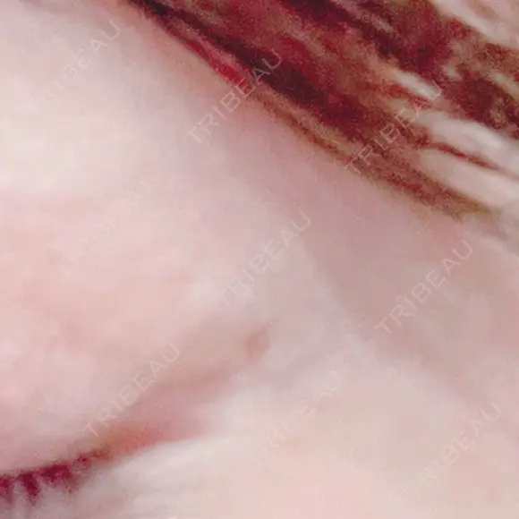 アートメイク（ほくろ） oneUPclinic BEFORE メイン用