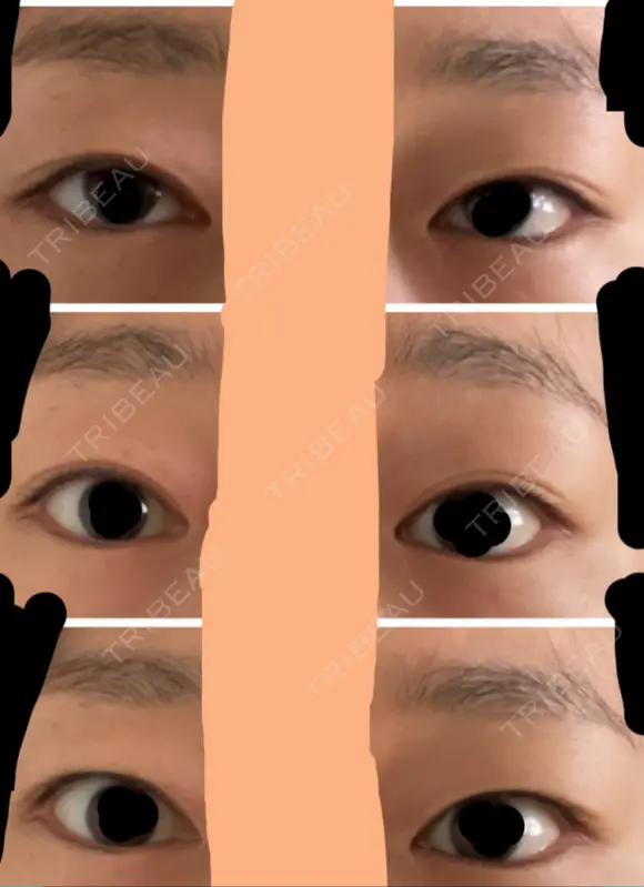 二重切開 / 眼瞼下垂（切開） / 上まぶたたるみ取り / 上まぶたの脂肪取り 城本クリニック 名古屋院 BEFORE メイン用