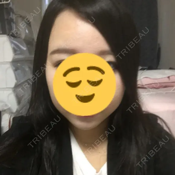 バッカルファット除去 / 脂肪吸引（顔） / ボトックス（エラ・小顔） / ヒアルロン酸注入（額） エートップ美容整形外科 BEFORE メイン用