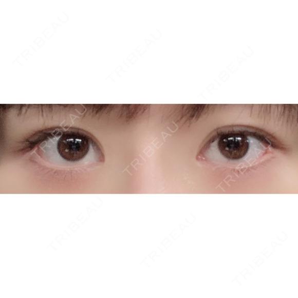 二重切開 / 眼瞼下垂（切開） / その他（目元） / 上まぶたたるみ取り / 上まぶたの脂肪取り / 目元修正 リビジョンクリニック（旧：池本形成外科・美容外科） BEFORE メイン用