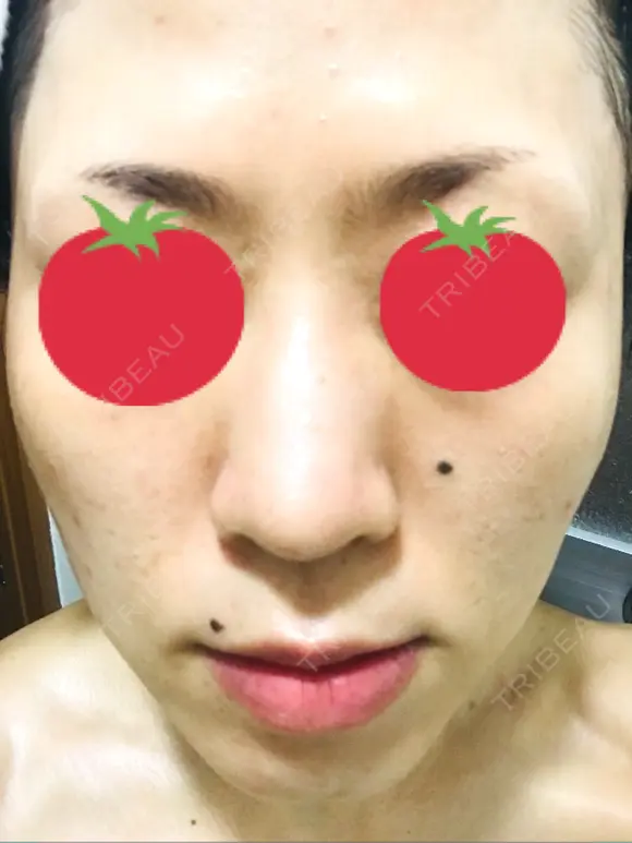 その他（肌） / ピーリング（ニキビ・毛穴） / イオン導入 / フォトシルクプラス / 光治療（フォトフェイシャルなど） / ウーバーピール / ニキビ治療 ハニークリニック BEFORE メイン用